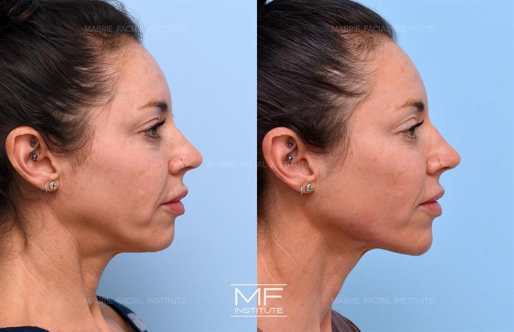 Before and after jawline filler to make you look younger case #738