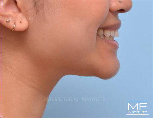 Woman after BOTOX treatment for dimpled chin