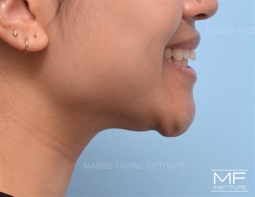 Woman before BOTOX treatment for dimpled chin