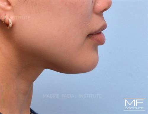 Woman after receiving BOTOX to increase chin projection