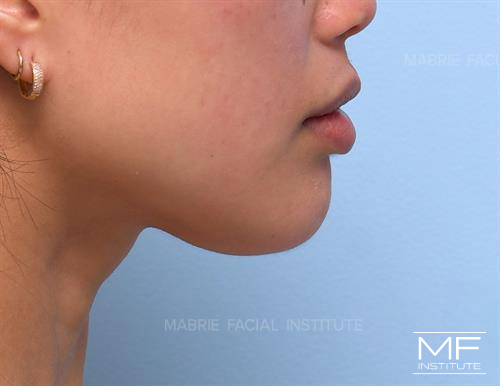 Woman before receiving BOTOX to increase chin projection