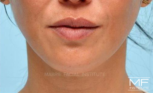 Woman after Mentalis (Chin) BOTOX