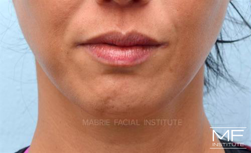 Woman before Mentalis (Chin) BOTOX