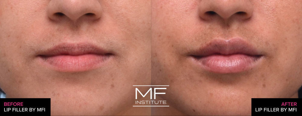 Before and after lip filler case #525