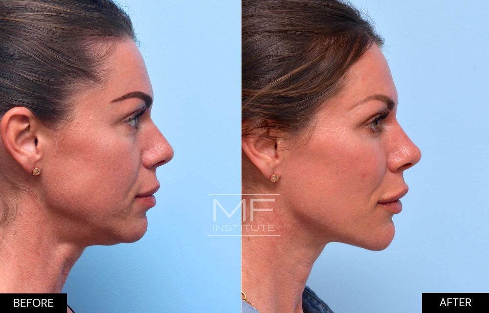 Before and after chin and jawline filler case #642