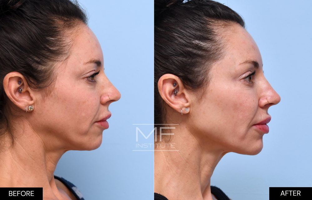 Before and after chin and jawline filler case #738