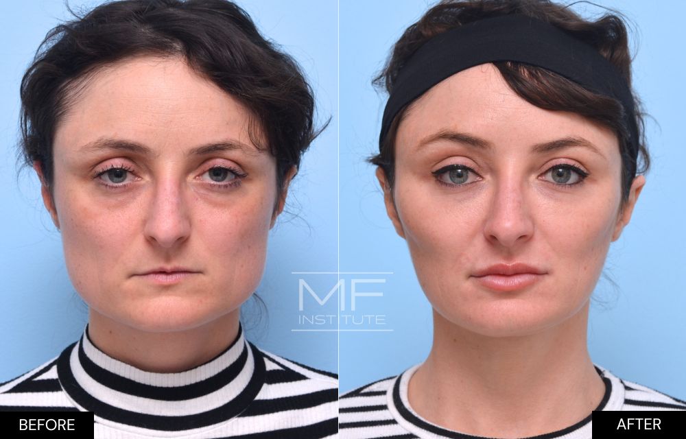 Before and after chin and jawline filler case #1004