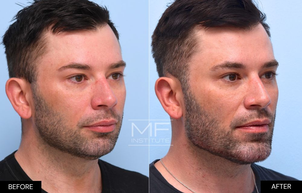 Before and after chin and jawline filler case #726