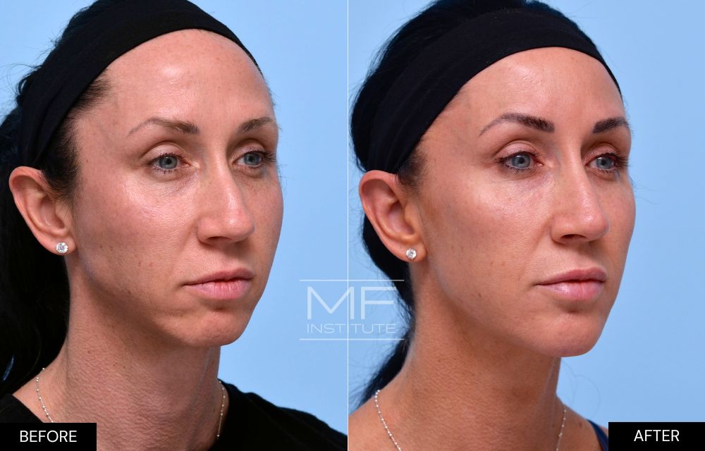 Before and after chin and jawline filler case #624