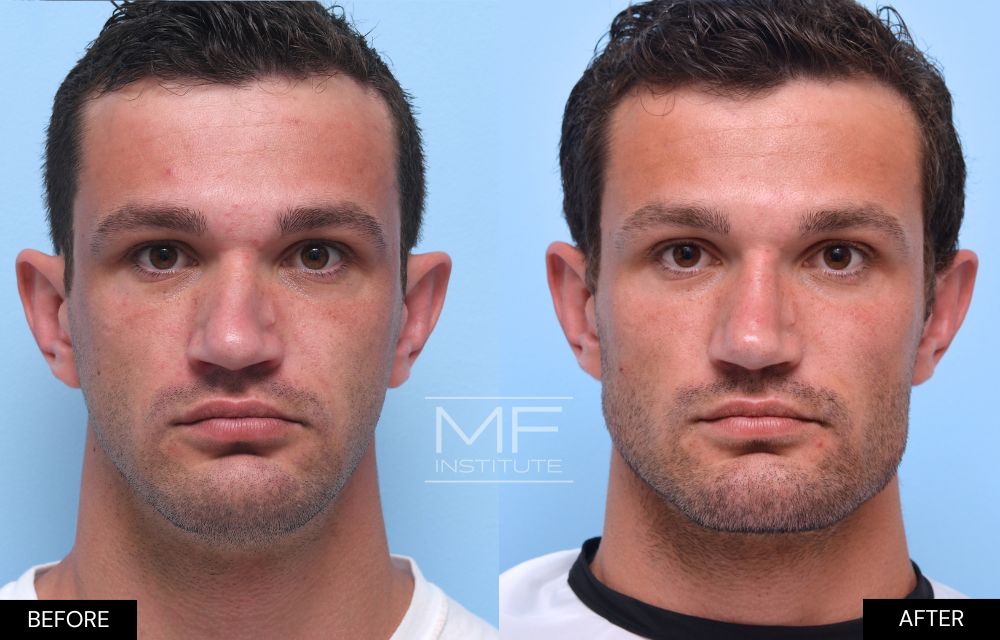 Before and after chin and jawline filler case #1193