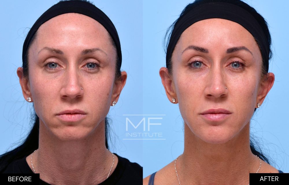 Before and after chin and jawline filler case #624