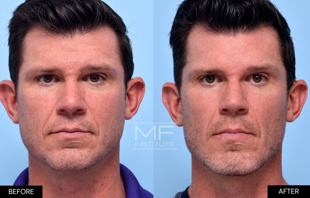 Before and after chin and jawline filler case #690