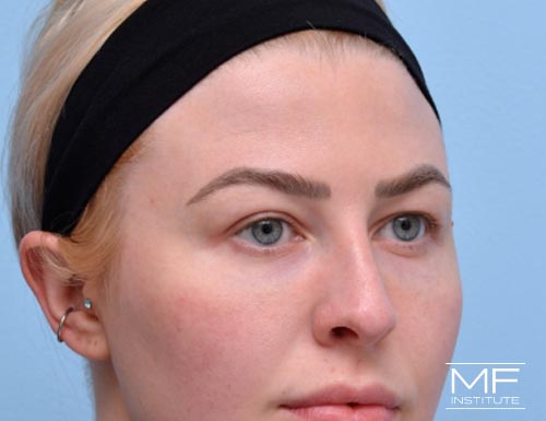 Woman after BOTOX Brow Lift treatment