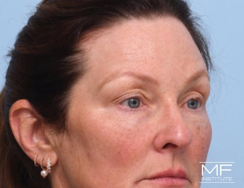 Woman after BOTOX Brow Lift treatment