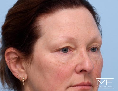 Woman before BOTOX Brow Lift treatment