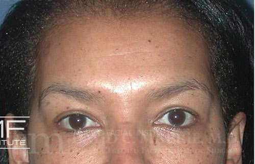 Woman after BOTOX for Forehead & Brow Package