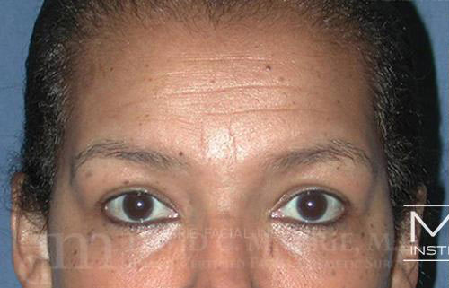 Woman before BOTOX for Forehead & Brow Package