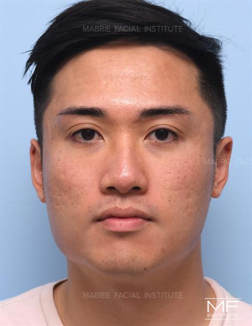 Man before Botox for masseter and jaw treatment.