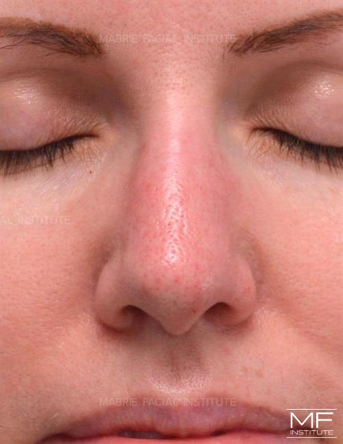 Woman after nonsurgical nose job, focusing on the nostrils and the columella.