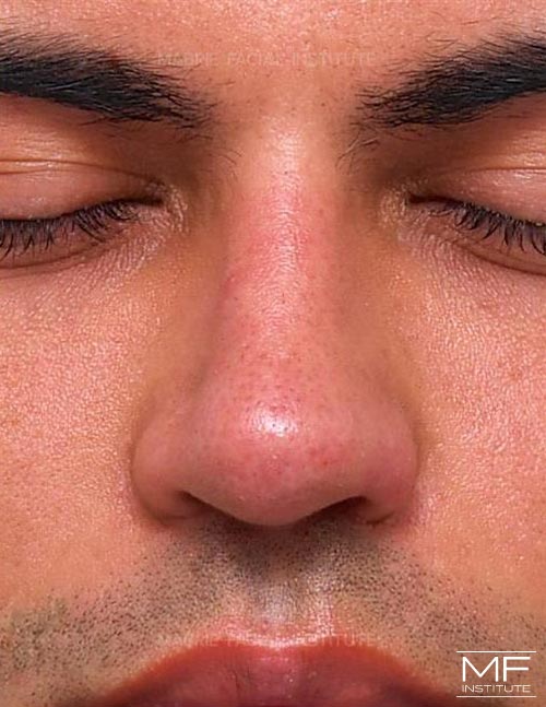 Man after nonsurgical nose job, focusing on the nostrils and the columella.