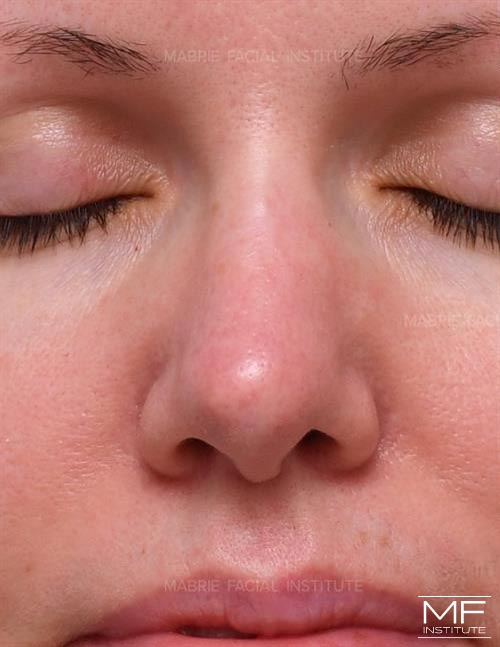 Woman before nonsurgical nose job, focusing on the nostrils and the columella.