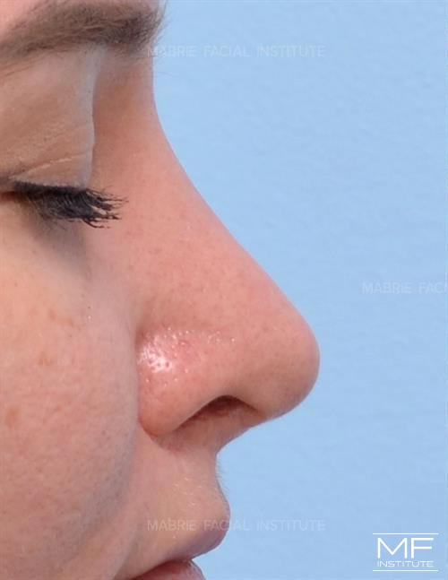 Woman before nonsurgical nose job, focusing on the nostrils and the columella.