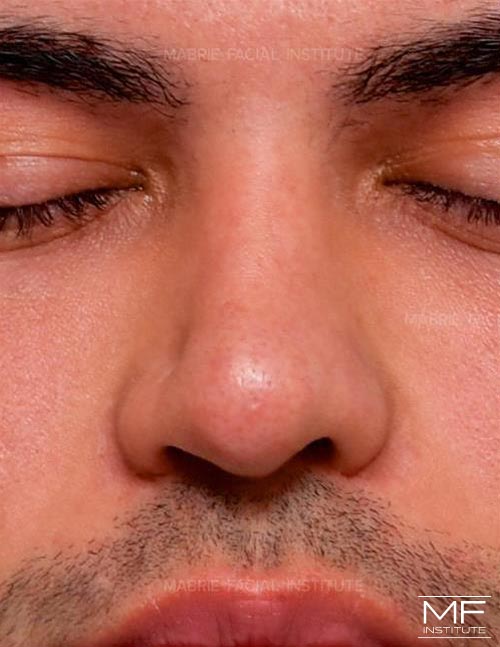 Man before nonsurgical nose job, focusing on the nostrils and the columella.