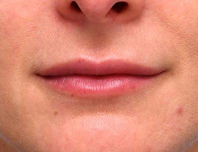 Close up of a woman's lips, one week after lip filler treatment.