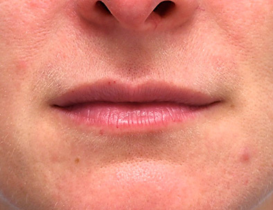 Close up of a woman's lips, before lip filler treatment.