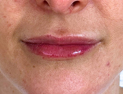 Close up of a woman's lips, one day after lip filler treatment.