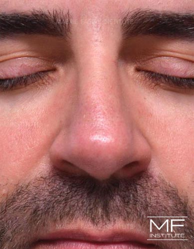 Closeup of a man's nose after nonsurgical nose job with fillers treatment.