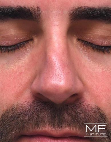 Closeup of a man's nose before nonsurgical nose job with fillers treatment.