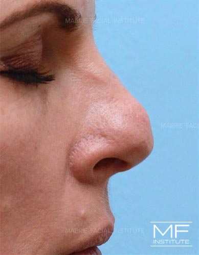 Woman before non surgical nose job after rhinoplasty surgery.