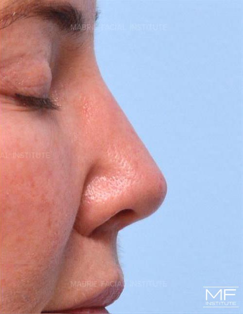 Woman after nonsurgical nose job, focusing on the nostrils and the columella.