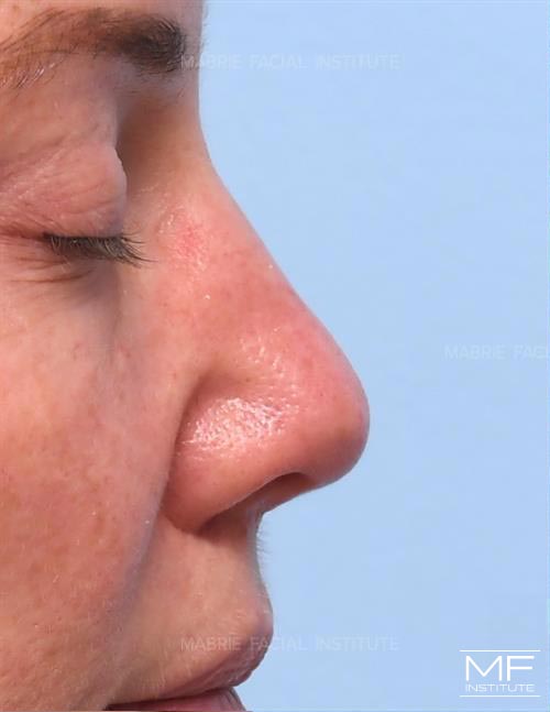 Woman before nonsurgical nose job, focusing on the nostrils and the columella.