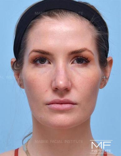 Woman after BOTOX & Filler for the Round Face treatment package.