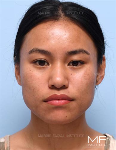 Woman before BOTOX & Filler for the Round Face treatment package.