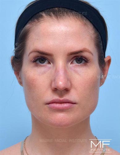 Woman before BOTOX & Filler for the Round Face treatment package.