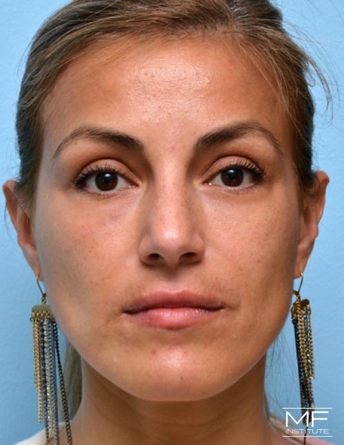 Woman after Complete Under Eye Rejuvenation.