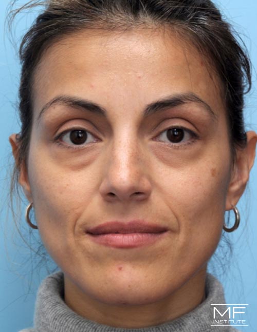 Woman before Complete Under Eye Rejuvenation.