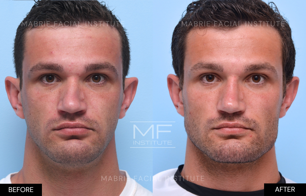 Before and after chin and jawline filler case #1193