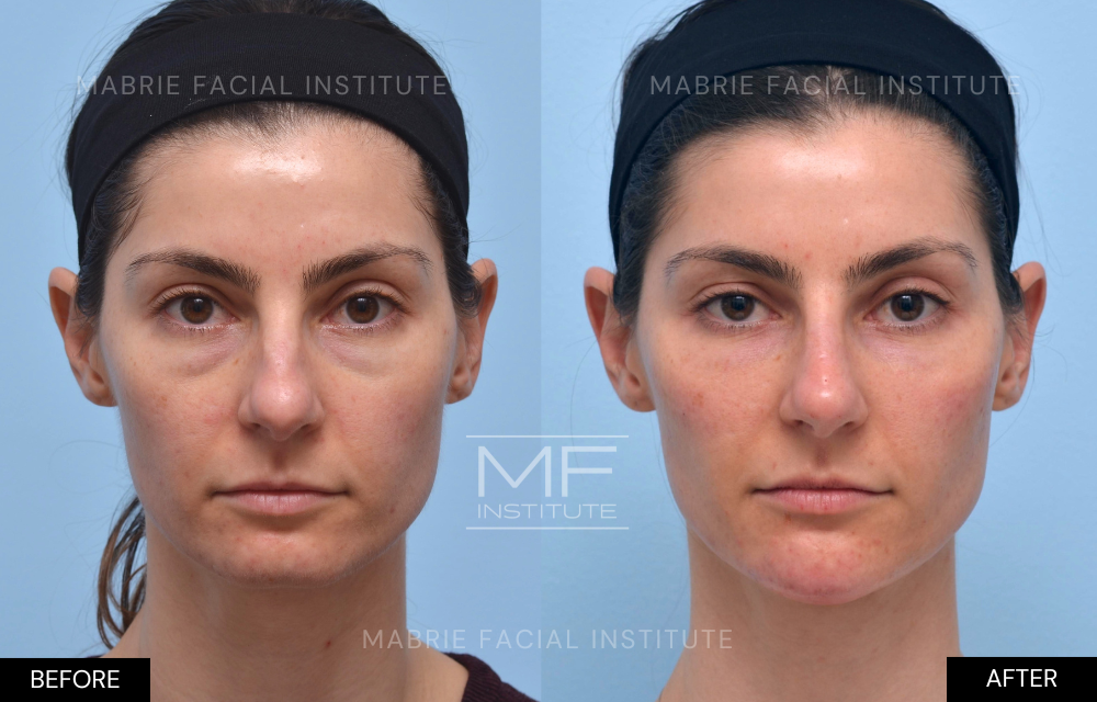 Before and after chin and jawline filler case #519