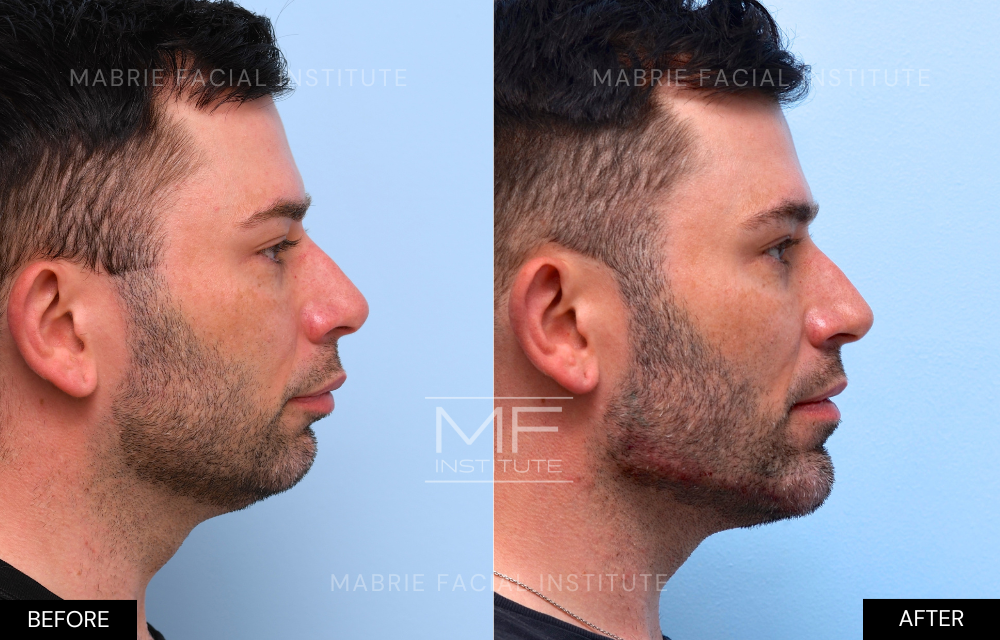 Before and after chin and jawline filler case #726