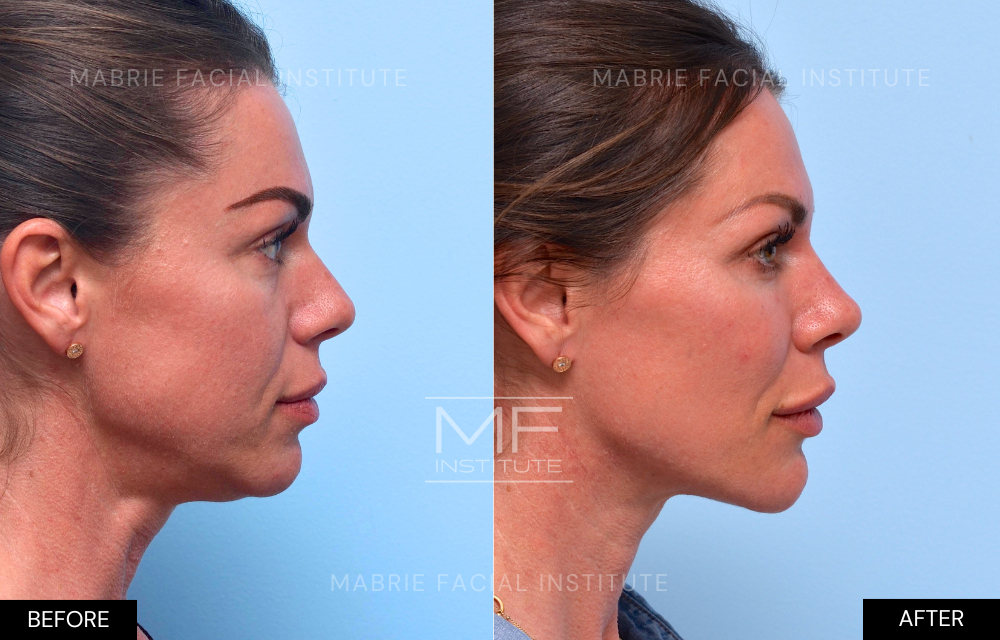 Before and after chin and jawline filler case #642