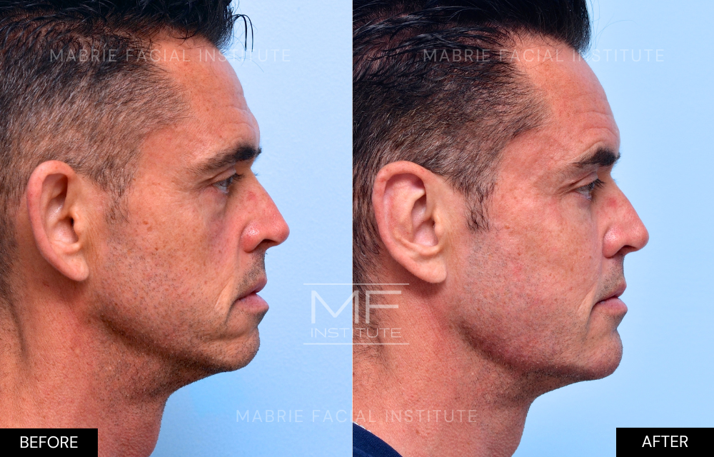 Before and after chin and jawline filler case #645