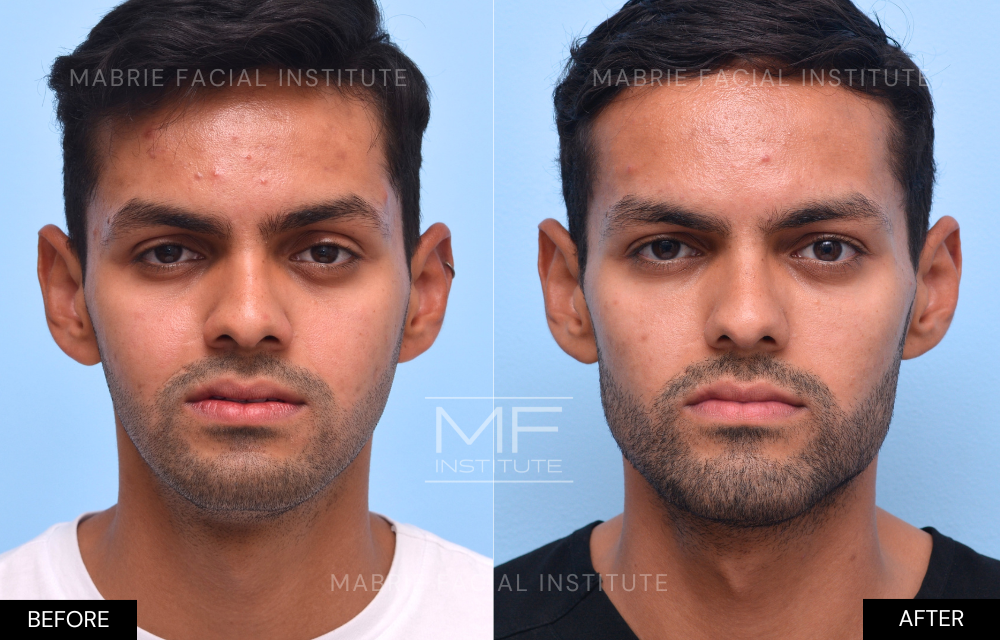 Before and after chin and jawline filler case #721