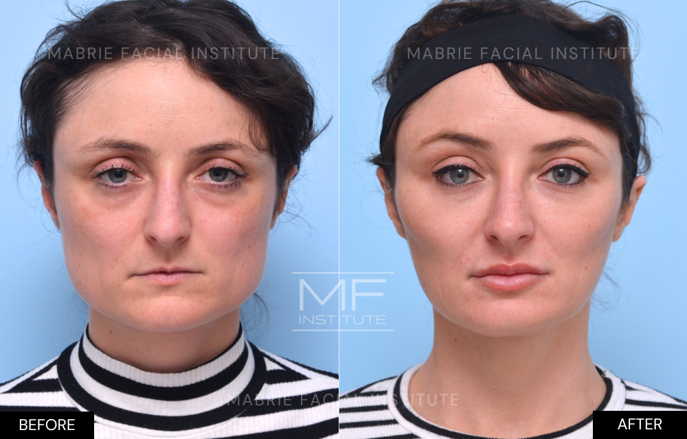 Before and after chin and jawline filler case #1005