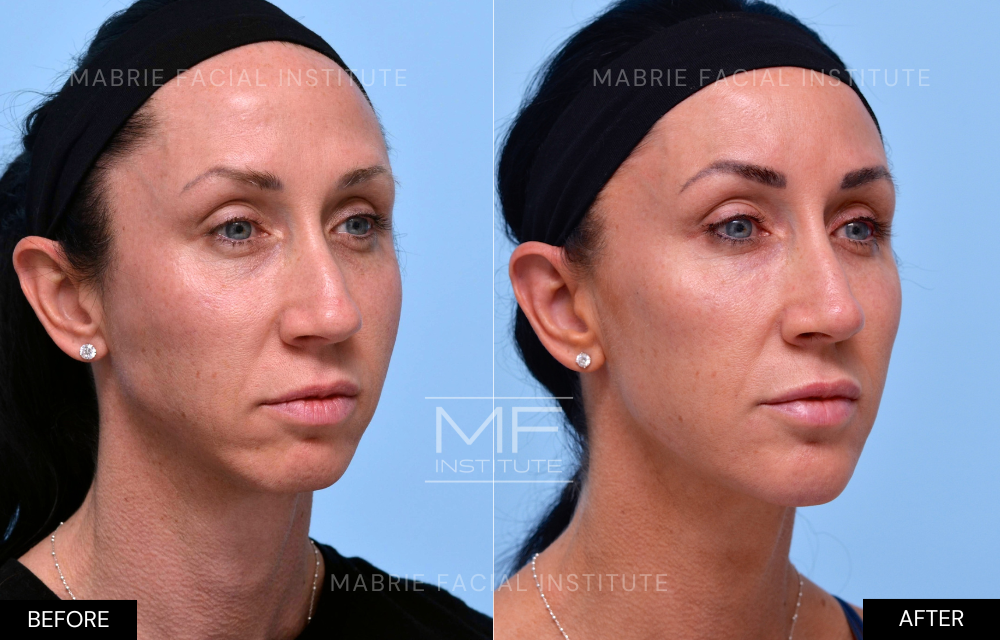 Before and after chin and jawline filler case #624