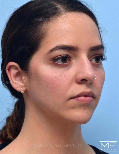 Woman after non surgical cheek augmentation with filler.