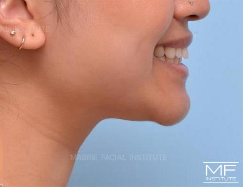 Woman after BOTOX in the Chin (Mentalis BOTOX) treatment.